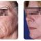 Frakční laserový resurfacing