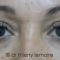 Lipofilling du visage
