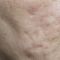 Scar removal
