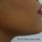 Génioplastie - Chirurgie esthétique du menton