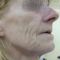 Lifting du visage