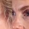 Brow lift