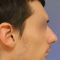 Rhinoplastie