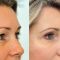 Operácia očných viečok (Blepharoplastika)