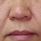 Dermabraze