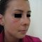 Operácia nosa (Rhinoplastika)