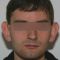 Ear surgery (Otoplasty)