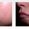 Kwas hialuronowy: Saypha, Restylane, Juvederm, Stylage