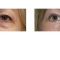 Eyelid surgery (Blepharoplasty)