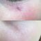 Spider veins laser removal (redness, birh marks)