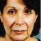 Facelift