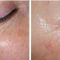 Fotorejuvenace / Resurfacing