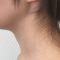 Génioplastie - Chirurgie esthétique du menton
