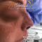 Rhinoplastie