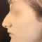 Rhinoplastie