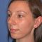 Rhinoplasty (Nose Job)