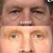 Blépharoplastie