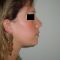 Génioplastie - Chirurgie esthétique du menton