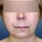 Facelift (operace obličeje), SMAS lifting