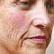 Traitements laser - dermatologie esthétique
