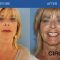 Lifting facial