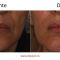Hyaluronic acid-based wrinkle fillers