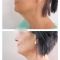 Facelift, SMAS facelifting