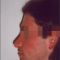 Plastika nosu (Rhinoplastika)