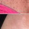 Rimozione tatuaggi - laser