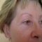 Fotorejuvenace / Resurfacing