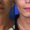 Lifting du visage