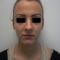 Otoplastie (Chirurgie esthétique des oreilles)