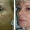 Antiaging