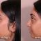 Rhinoplastie