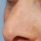 Operácia nosa (Rhinoplastika)