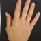 Mesoterapia (rivitalizzazione del viso, collo, decoltè, mani)