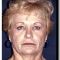 Lifting facial