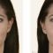 Kwas hialuronowy: Saypha, Restylane, Juvederm, Stylage