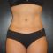 Liposukcia laserová - SmartLipo