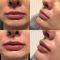 Kwas hialuronowy: Saypha, Restylane, Juvederm, Stylage