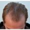 Trapianto capelli