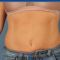 CoolSculpting