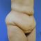 Liposuccion