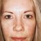 Procedure laser in dermatologia estetica