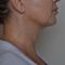 Exilis (Nicht-invasives Lifting)