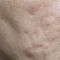 Laser Scar Treatment