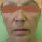 Facelift