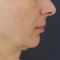 Facelift