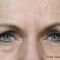 Nichtchirurgische Faltenbehandlung - BOTOX® / DYSPORT®