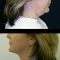 Liposuction